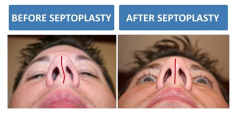 The <b>septoplasty</b> is to correct. . Is septoplasty worth it reddit